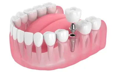 Get A Second Opinion For Dental Implants