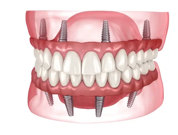 All-On-4 Dental Implants Danville | Expert Dental Implant Surgeon in the Bay Area
