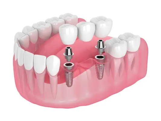 Multiple Dental Implants Danville | Diablo Valley Dental Implants | Dental Implant Surgeon