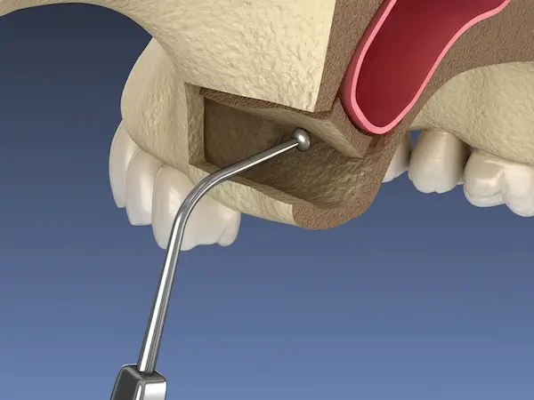 Sinus Lift Danville | Diablo Valley Implant Dentistry